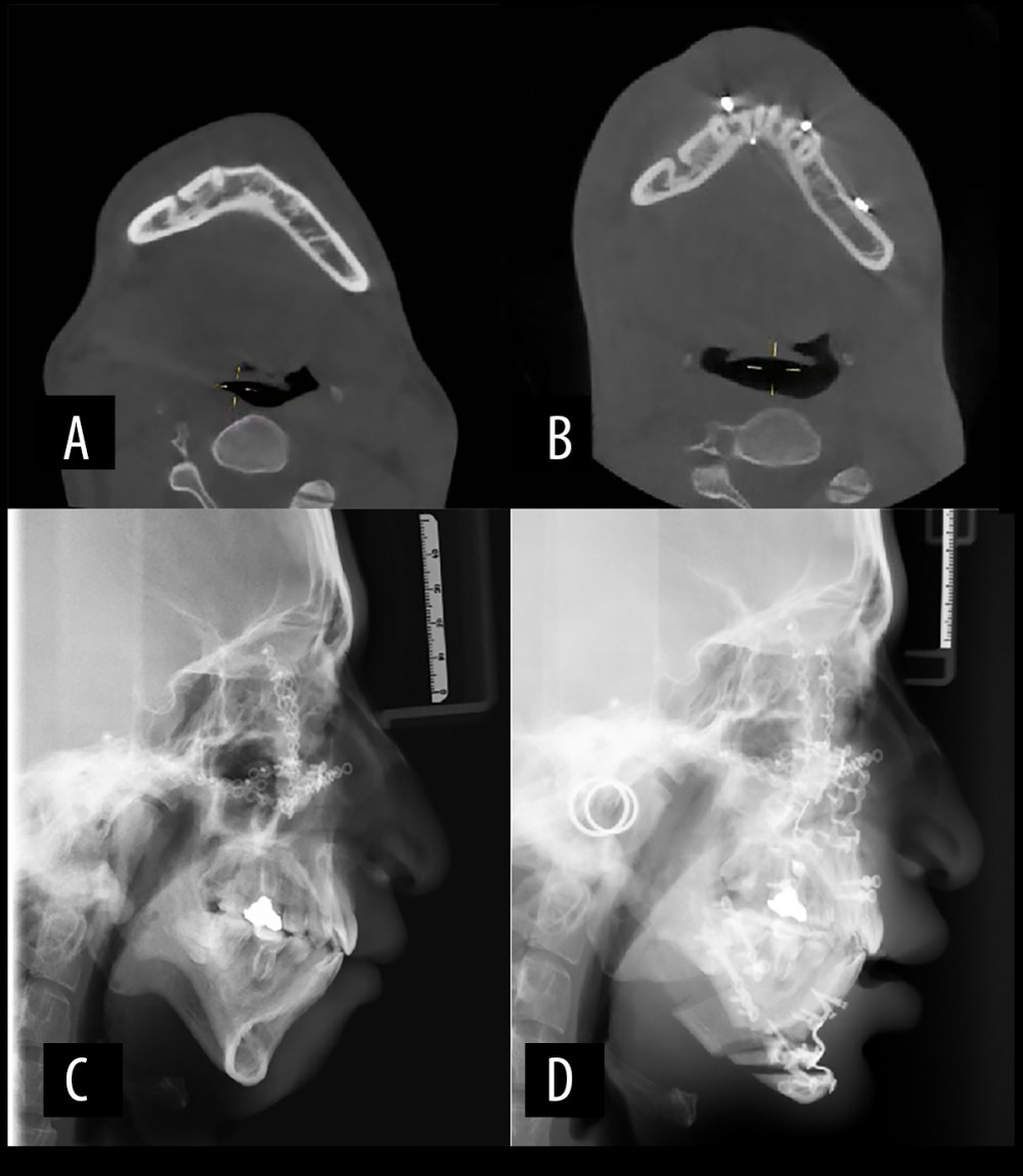 Imaging comparison of skeletal and airway changes after orthognathic surgery. (A, B) Preoperative and postoperative axial cone beam computed tomography images demonstrating the minimum airway width. (C, D) Preoperative and postoperative lateral cephalograms.