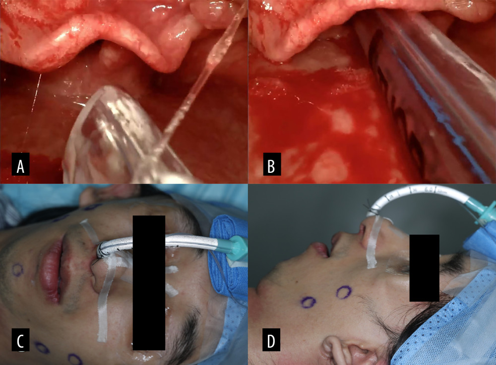 Videolaryngoscopy-guided tracheal intubation. (A) Glottic view before tube insertion. (B) Endotracheal tube positioned within the trachea. (C, D) Frontal and lateral views of the patient after successful intubation.