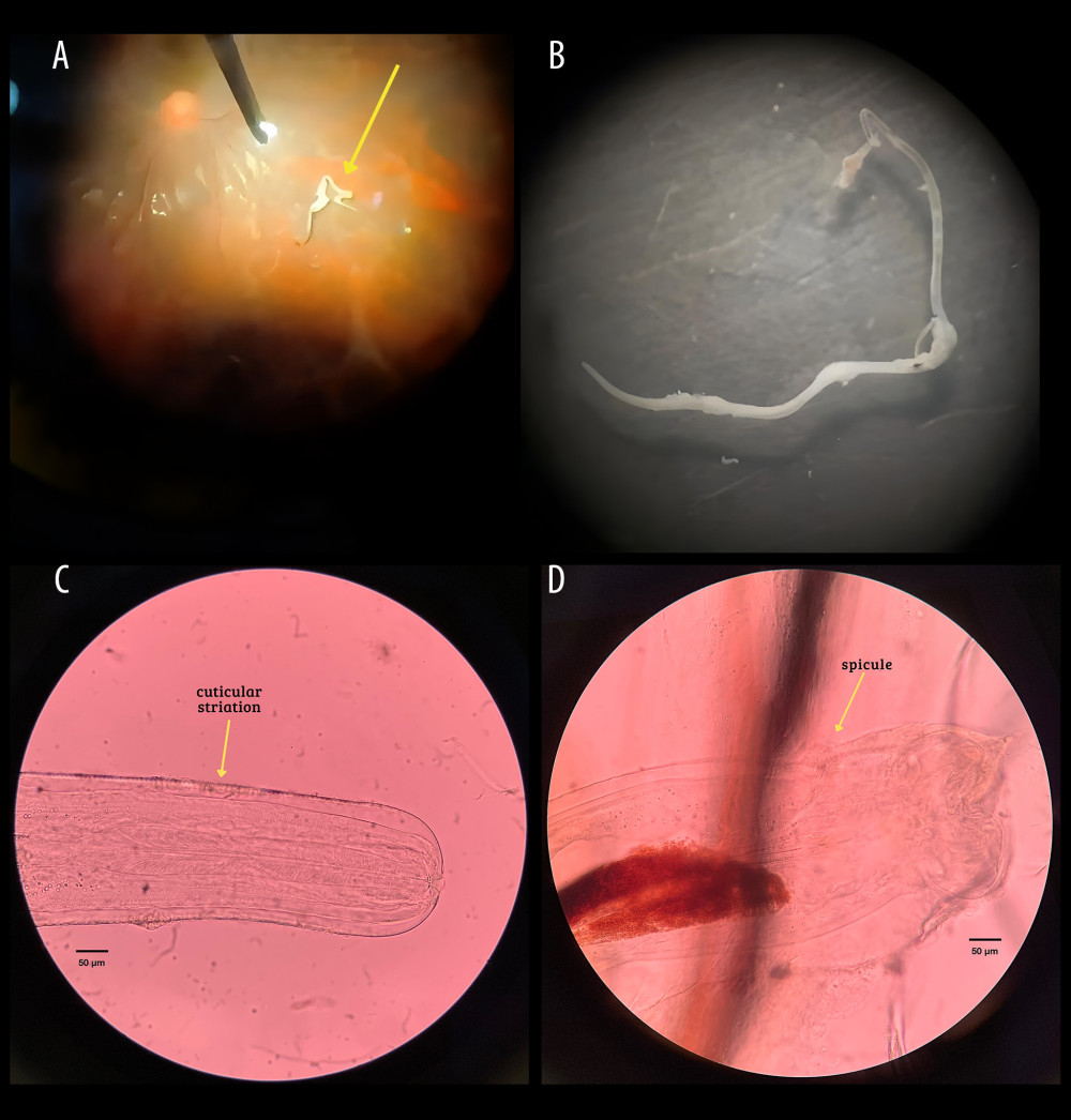 Parasite identification. (A) Intravitreal worm observed during the vitrectomy procedure; (B) cuticular striations at the anterior end of Onchocerca lupi; (C) short posterior spicule of O. lupi; (D) thin, thread-like, white adult O. lupi worm (12 mm × 320 μm).