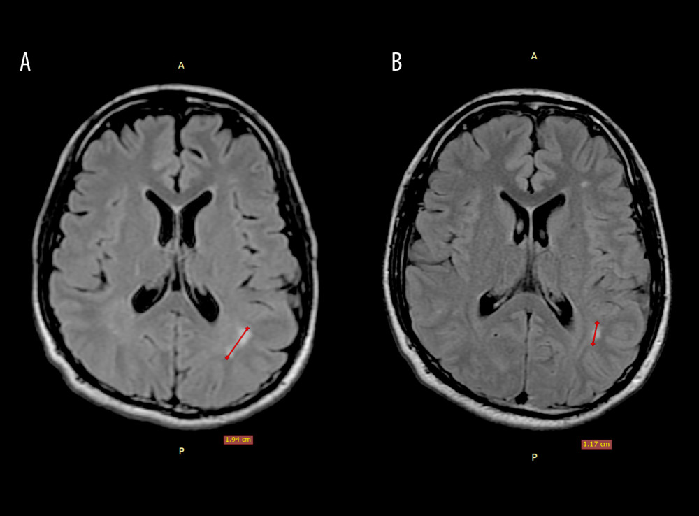 Brain magnetic resonance images of a 24-year-old man with vitreous Onchocerca lupi infection. (A) Hyperintense lesion in the white matter of the left parietal lobe on T2-weighted fluid-attenuated inversion recovery (FLAIR) sequences; (B) follow-up magnetic resonance image at 9 months demonstrating persistence of the lesion, with a decrease in size.