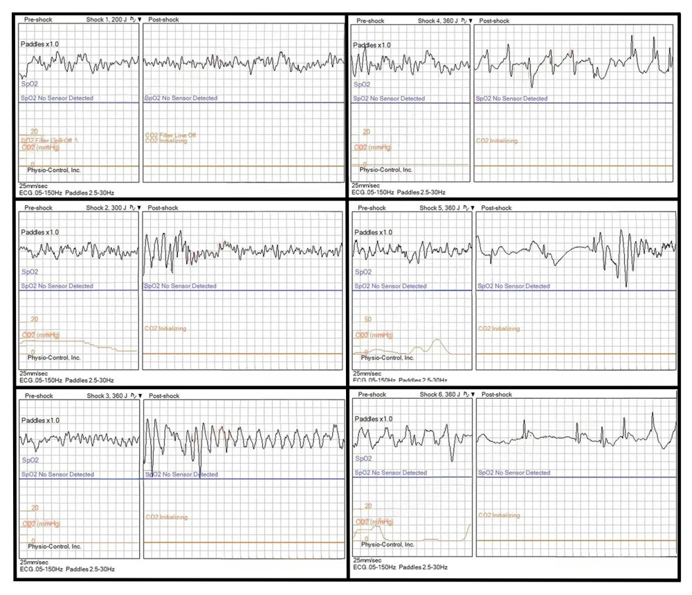 The initial defibrillation was delivered at 200 joules for ventricular fibrillation (top left). The second defibrillation was delivered at 300 joules for ventricular fibrillation (middle left). The third defibrillation was delivered at 360 joules for ventricular fibrillation, and the rhythm appears to have converted into ventricular tachycardia post-defibrillation (lower left). The fourth defibrillation was delivered at 360 joules for ventricular fibrillation, and the rhythm appears to have converted into an organized rhythm for a brief period of time post-shock (top right). The fifth defibrillation was delivered at 360 joules for ventricular fibrillation, and the rhythm appears to have once again converted into an organized rhythm for a brief period post-shock (middle right). The sixth defibrillation was delivered at 360 joules for ventricular fibrillation, and ROSC was obtained post-shock (lower right). ROSC, return of spontaneous circulation.