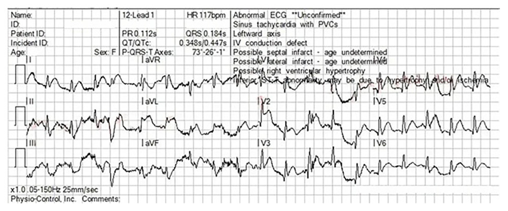 First 12-lead ECG post-ROSC. The ECG was complicated by significant artifacts due to patient noncompliance. ST-segment elevation was significant enough that emergency medical services clinicians activated the CCL based on these findings. ECG, electrocardiogram; ROSC, return of spontaneous circulation; CCL, cardiac catheterization lab.