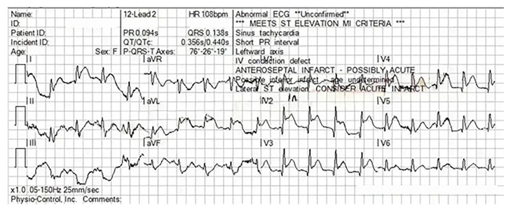 Second 12-lead ECG. There is a marked improvement in artifact levels with this ECG. This demonstrates clear ST-segment elevation in the anteroseptal leads with reciprocal depression. ECG, electrocardiogram.