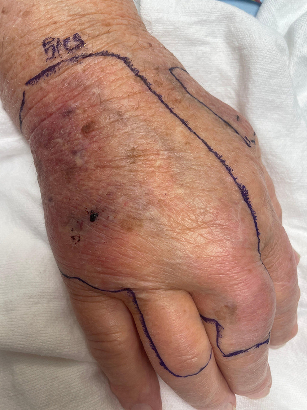 Dorsal right hand wound with associated erythema and edema.