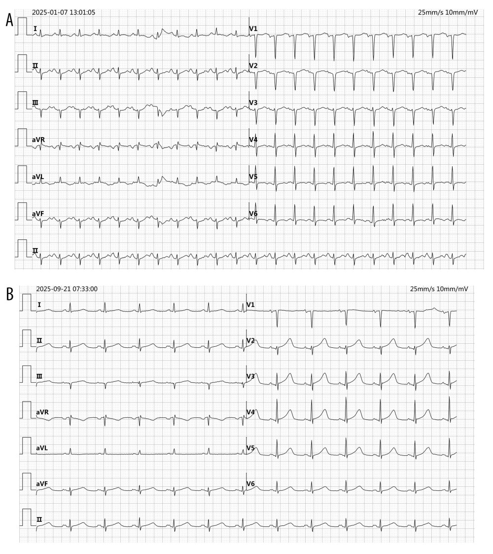 Electrocardiographic findings(A) Initial admission ECG demonstrating sinus tachycardia (131 bpm), abnormal Q waves in leads V1–V2, left axis deviation, poor R-wave progression, and T-wave abnormalities, suggestive of myocardial ischemia or injury. (B) ECG obtained during the second admission showing sinus rhythm (73 bpm), P-wave broadening, and a prolonged QT interval (474 ms), consistent with ongoing electrical instability in the context of catecholamine excess.