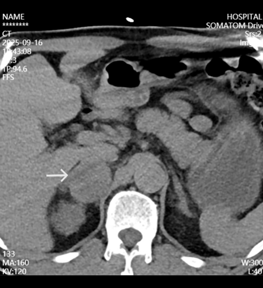 Abdominal computed tomographyAxial contrast-enhanced computed tomography scan revealing a well-defined right adrenal mass (arrow) exhibiting heterogeneous enhancement and imaging features characteristic of pheochromocytoma.