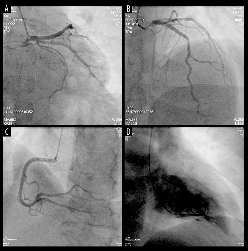 Coronary angiography findings(A–D) Selective coronary angiograms demonstrating no significant stenosis of the left anterior descending (A), left circumflex (B), or right coronary artery (C). An incidental small fistula from the right coronary artery to the right ventricle is noted (C, arrow). Left ventriculography (D) demonstrates normal chamber size and contractility, excluding obstructive coronary artery disease and supporting the diagnosis of myocardial infarction with non-obstructive coronary arteries (MINOCA).