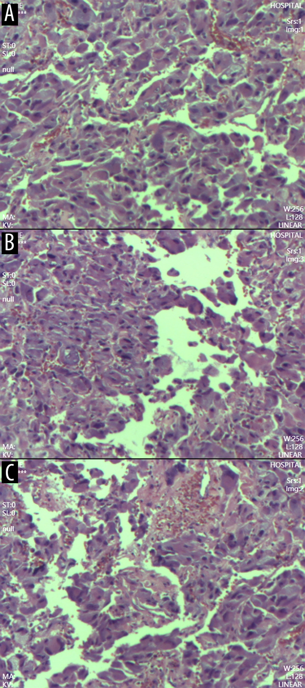 Pathological examination of the resected adrenal tumor(A) Gross specimen showing a cystic-solid adrenal tumor measuring 5 × 4 × 3 cm, with a central dark red hemorrhagic area, a peripheral pale yellow rim, and a 2-cm rupture. (B) Low-power photomicrograph (hematoxylin and eosin stain) demonstrating a trabecular and nested (Zellballen) growth pattern characteristic of pheochromocytoma. (C) High-power photomicrograph showing tumor cells with abundant eosinophilic cytoplasm, nuclear pleomorphism, and prominent sinusoidal vasculature. Extensive intratumoral hemorrhage is present. These histopathologic features confirm the diagnosis of right adrenal pheochromocytoma.
