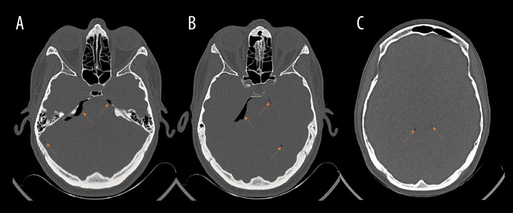 (A–C) Axial unenhanced CT on bone window showing pneumocephalus (arrows).