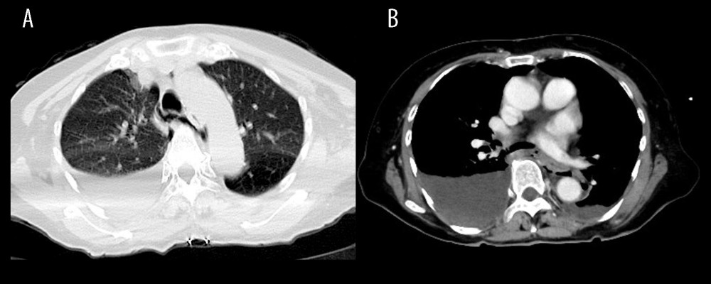 (A, B) Contrast-enhanced computed tomography revealing pneumomediastinum with periesophageal air, right pneumothorax, and right pleural effusion containing a high-density component.