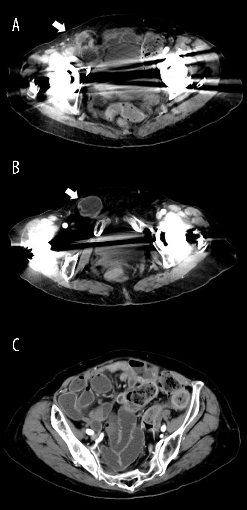 Contrast-enhanced axial computed tomography findings of the right inguinal hernia. (A) Small-bowel herniation at the internal inguinal ring (arrow). (B) Potentially incarcerated small bowel within the inguinal canal (arrow). (C) Mild localized proximal small-bowel dilatation.