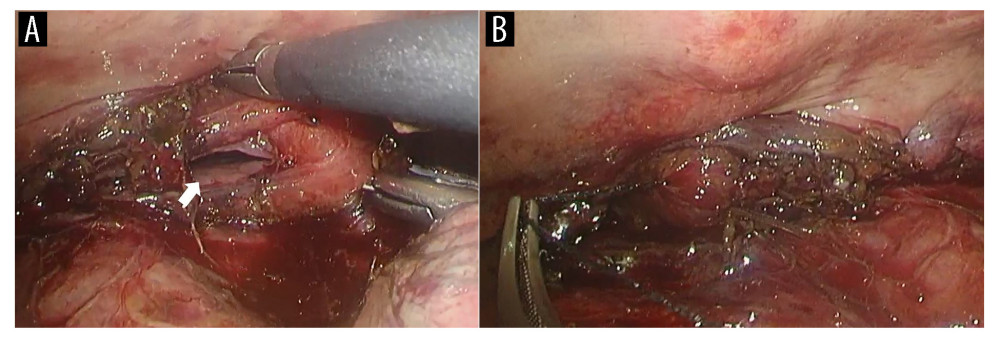 Thoracoscopic findings during surgical repair. (A) An approximately 35-mm longitudinal esophageal tear on the right wall of the lower thoracic esophagus (arrow). (B) The esophageal defect after closure with a continuous full-thickness suture using a 3-0 absorbable barbed monofilament.