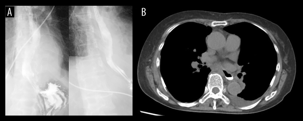 Postoperative imaging findings. (A) Contrast esophagography using Gastrografin demonstrating no evidence of leakage. (B) Computed tomography performed immediately after esophagography confirming the absence of leakage.