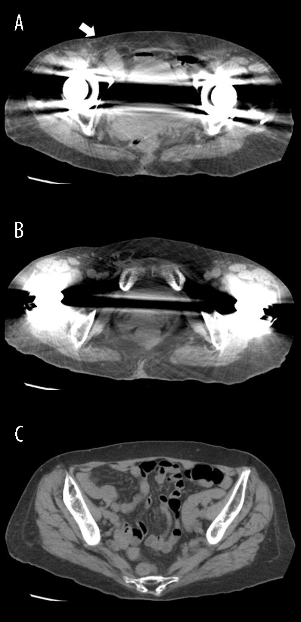 (A–C) Abdominal computed tomography findings. Axial contrast-enhanced computed tomography image demonstrating slight small-bowel protrusion through the inguinal orifice (arrow) without evidence of incarceration.