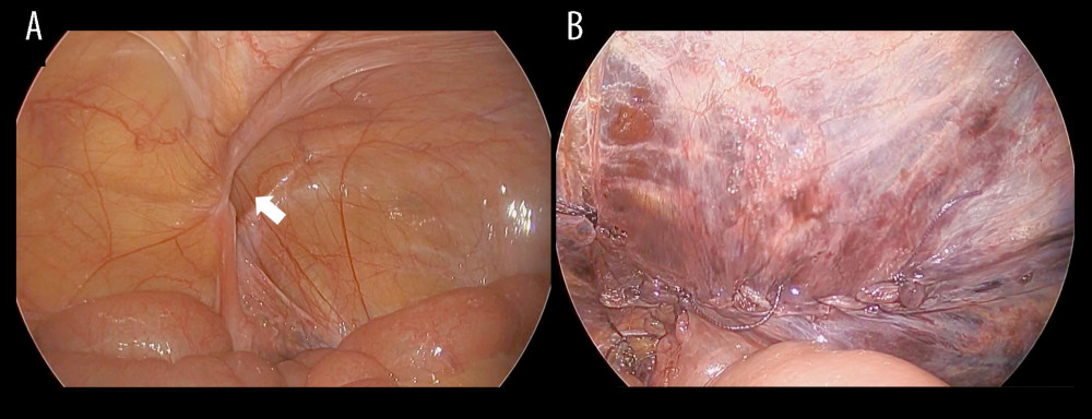 Laparoscopic findings during elective transabdominal preperitoneal repair. (A) Laparoscopic view demonstrating a right inguinal hernia with a small defect (arrow). (B) Laparoscopic view after mesh placement and peritoneal closure.