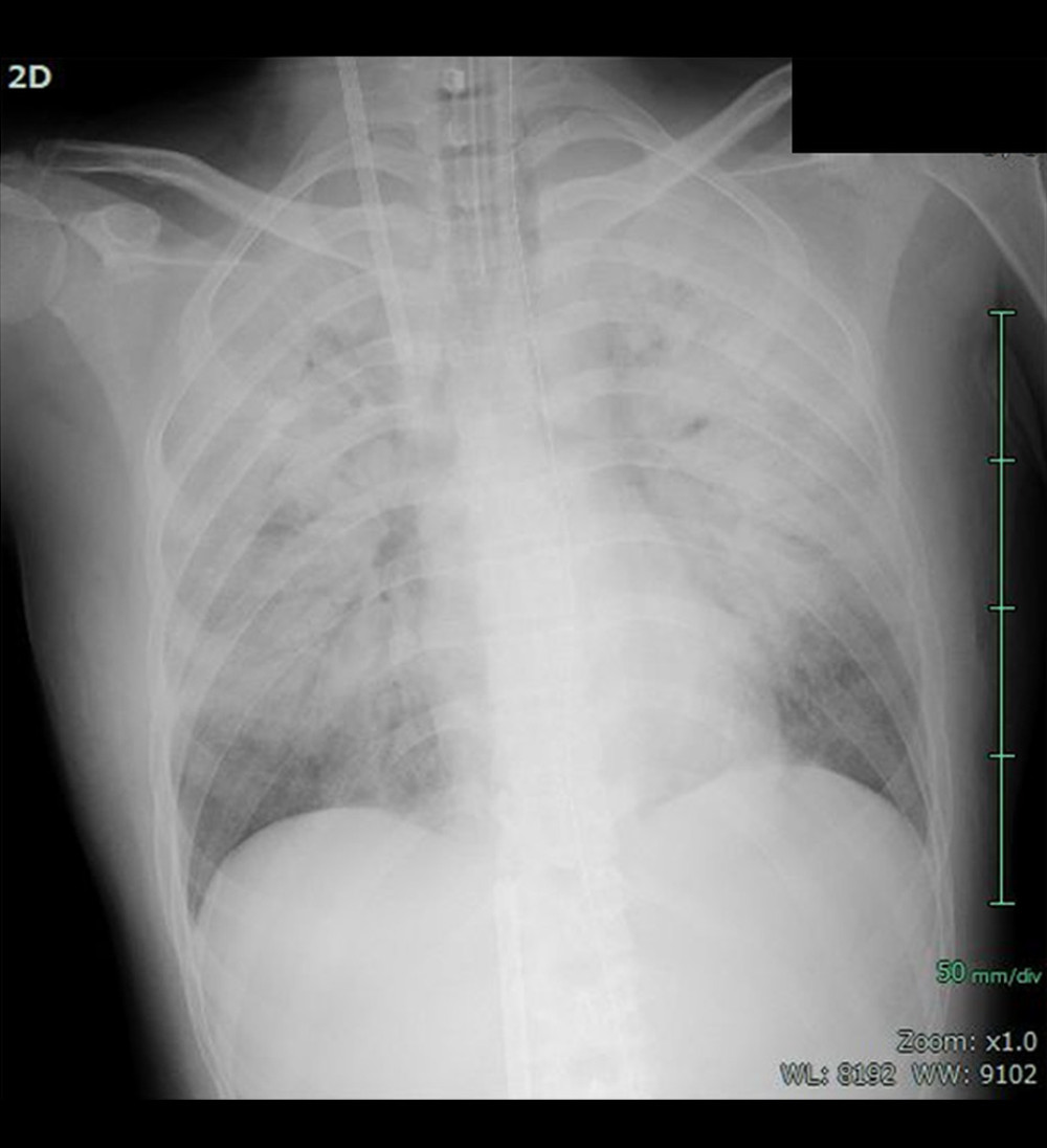 Chest X-ray examination on arrivalThe chest X-ray revealed that severe bilateral infiltrative shadows reflecting severe hypoxemia, acute respiratory distress syndrome, and multiple organ dysfunction.