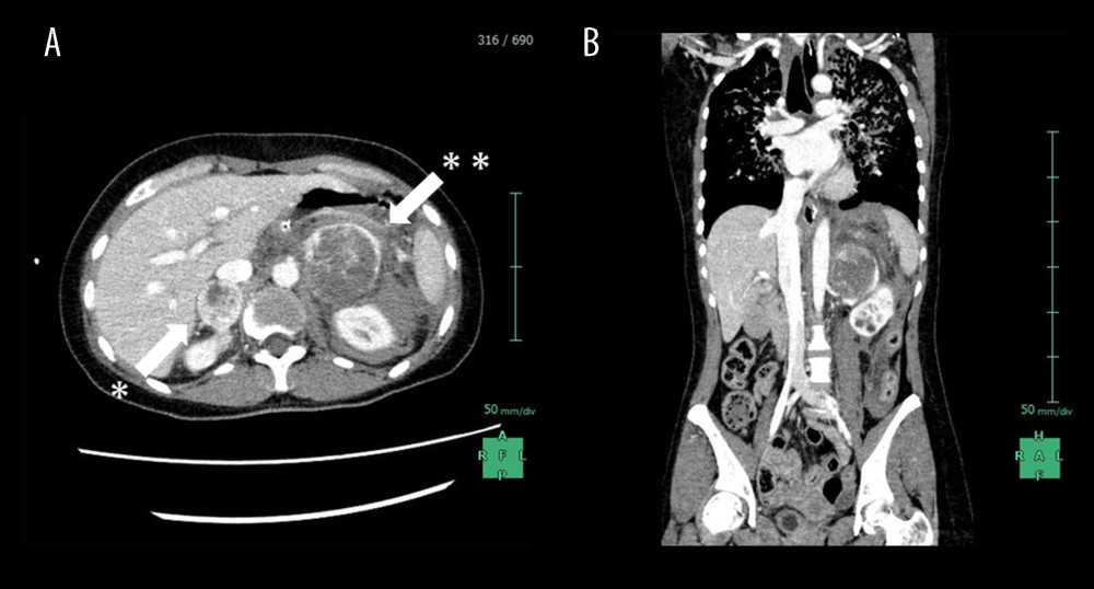 Enhanced CT examination on arrival(A) An enhanced CT examination detected bilateral adrenal gland tumors with 30 mm of the right side (white arrow*) and 60 mm of the left side in size (white arrow**). The tumor margins showed marked enhancement, while the interior of the bilateral tumors was low density, reflecting internal necrosis. These CT findings led to the diagnosis of bilateral pheochromocytomas. (B) Fluid collection was mainly observed around the left adrenal tumor. This fluid collection was caused by the rupture of the left adrenal tumor due to internal necrosis.