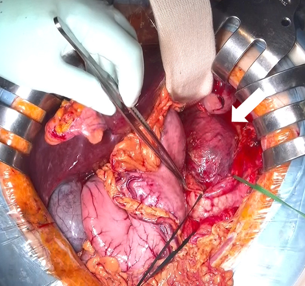 Intraoperative finding of the left-sided pheochromocytomaThe left-sided pheochromocytoma (whit arrow) was enlarged beyond the inferior border of the pancreas. We successfully performed left adrenalectomy without combined resection of the distal pancreas.