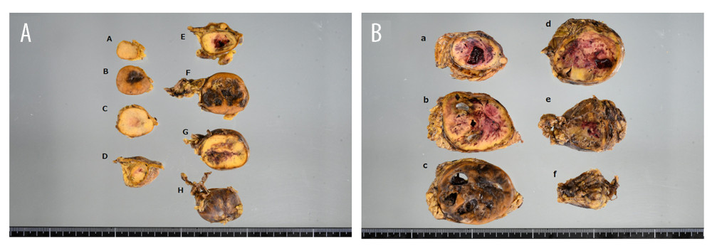 Macroscopic findings of the resected specimens(A) The size of right-side tumor was 70 × 40 mm, and the tumor had a fibrous capsule. Necrosis was observed in the center of the tumor. Internal necrosis was a typical finding of pheochromocytoma. (B) The size of left-side tumor was 80 × 65 mm, and the tumor had a fibrous capsule. Necrosis and intratumoral hemorrhage were observed inside the tumor. Internal necrosis and intratumoral hemorrhage were also typical findings of bulky pheochromocytoma.