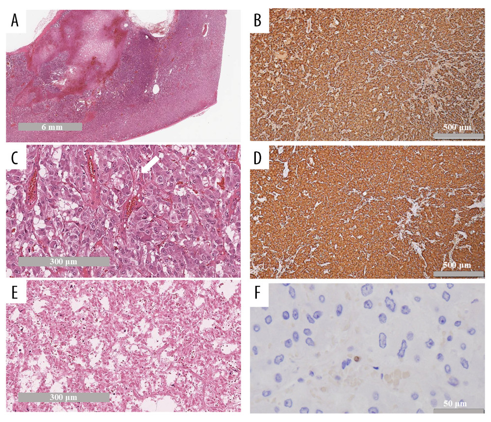 Histopathological findings of the resected specimens(A) The tumor was composed of eosinophilic and basophilic cells, and had a fibrous capsule (HE stain, low-power field). (B) The tumor shows a trabecular or alveolar (Zellballen) architecture, with nests separated by peripheral capillaries (white arrow). The cells showed pleomorphism, and the cytoplasm showed finely granular, amphophilic staining with a range from basophilic to acidophilic (HE stain, high-power field). (C) The center part of the tumor was massively necrotizing (HE stain, high-power field). (D) Tumor cells were strongly positive for chromogranin A, which is a highly useful marker of neuroendocrine granules. (Immunohistochemistry, high-power field). (E) Tumor cells were also strongly positive for synaptophysin (Immunohistochemistry, high-power field). (F) Ki-67 index was < 1% (immunohistochemistry, high-power field).