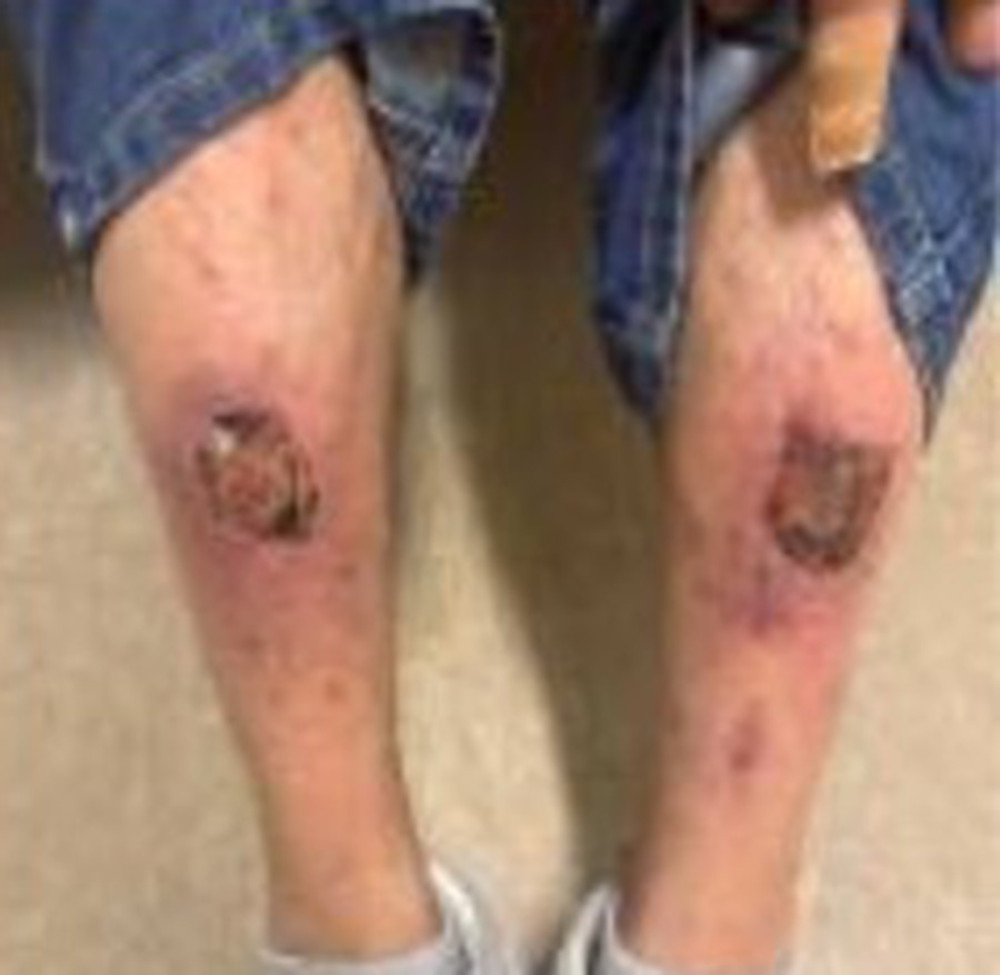 The initial wound presentation in-clinic on the shins of a patient with chronic, uncontrolled type 2 diabetes mellitus. The subacute leg blisters had been ongoing for 1 month.