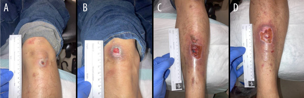 Day 7 after initial presentation, right and left anterior knee and lower leg ulcers. (A) Right anterior knee ulcer showing dry, red tissue. The periwound was dry, intact, and hyperpigmented. Size: 0.9 × 0.8 × 0.1 cm. (B) Left anterior knee ulcer with dry, red tissue. The periwound was dry and hyperpigmented. Size: 0.7 × 1 × 0.1 cm. (C) Right anterior lower leg ulcer with dry, red tissue with red granulation. The periwound was dry and intact, and with blanchable erythema. Size: 3.9 × 3.4 × 0.1 cm. (D) Left anterior lower leg ulcer with red tissue and yellow slough. The periwound was dry and intact, with blanchable erythema. Size: 7.2 × 3.6 × 0.1 cm.