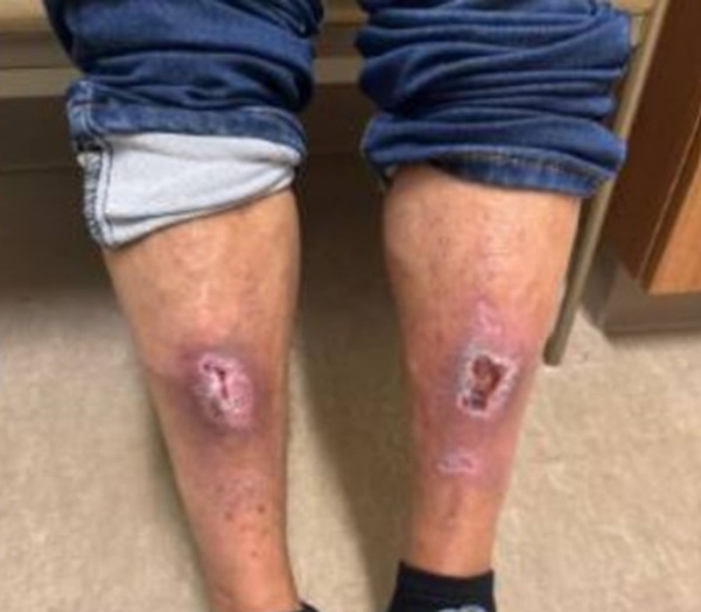 Follow-up image of the patient’s bilateral lower extremity wounds, notably on the anterior knees, at a post–wound-care clinic visit. Partial healing with visible scabbing was evident. The patient continued to follow up with wound care.