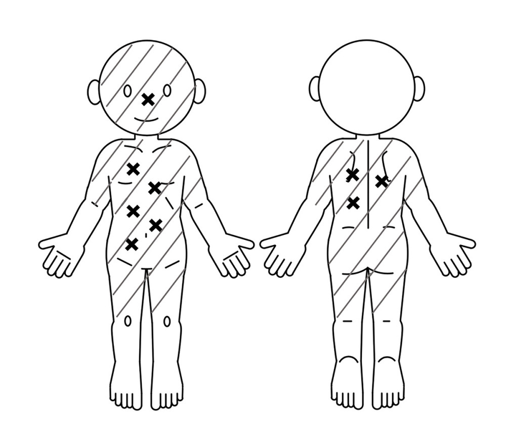 Distribution of bite sites and systemic cutaneous manifestationsCross marks indicate the sites of centipede bites (nose, chest, abdomen, and back). Shaded areas indicate the distribution of urticaria and angioedema, including non-bitten regions such as the upper arms and thighs. This schematic illustration is intended solely as a visual representation based on the family’s report and does not constitute direct clinical documentation of observed findings.