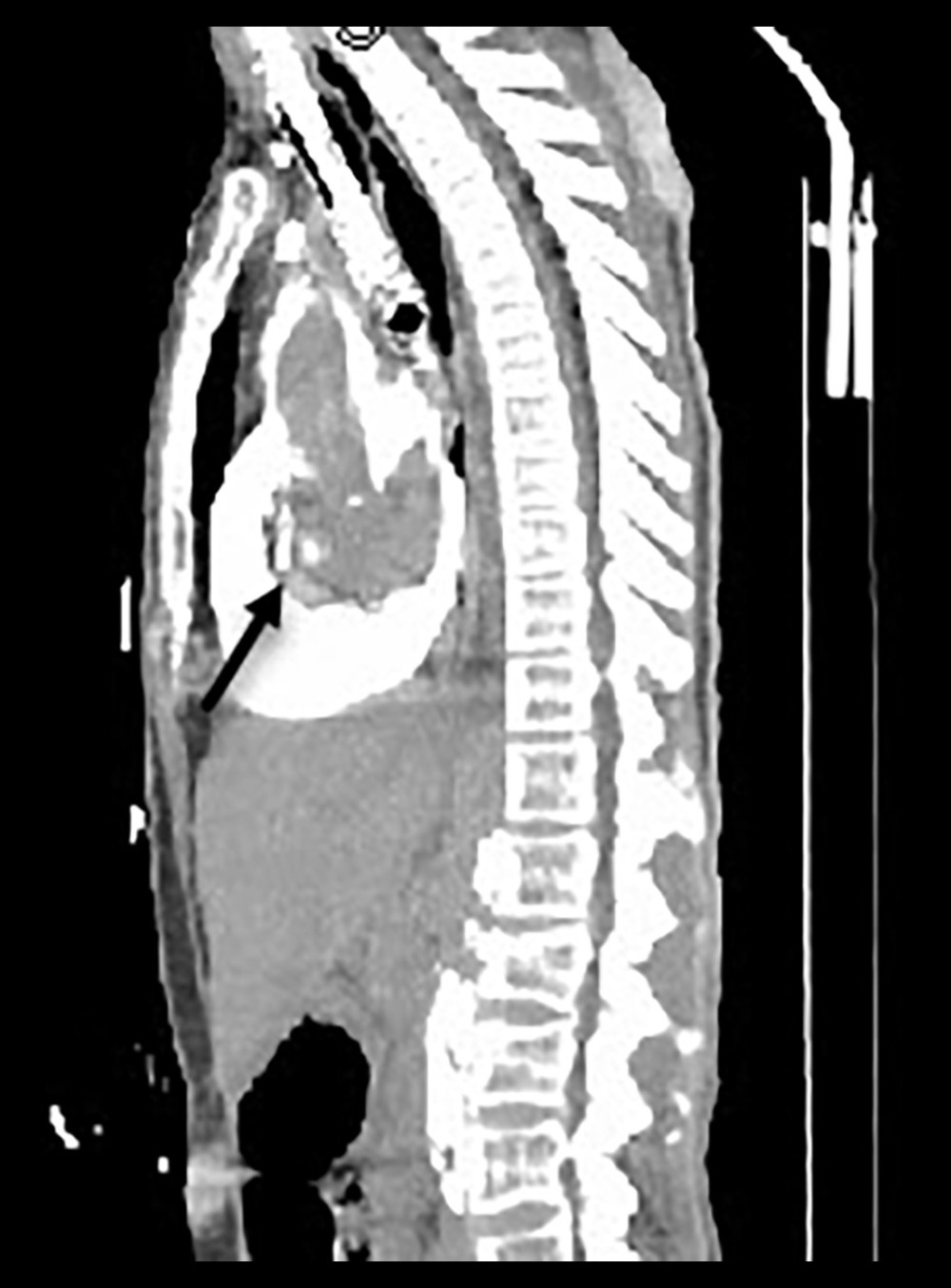 Sagittal contrast-enhanced computed tomography reconstruction demonstrating dense contrast accumulation within the pericardial sac, consistent with intrapericardial contrast extravasation resulting in cardiac tamponade. Arrow indicates the hyperdense pericardial collection.