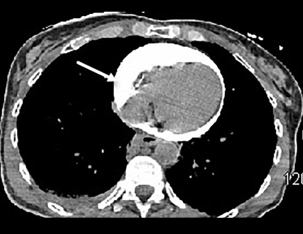 Axial contrast-enhanced computed tomography image showing circumferential hyperdense pericardial effusion compressing the cardiac chambers, consistent with contrast extravasation into the pericardial space. Arrow indicates the hyperdense effusion surrounding the heart.