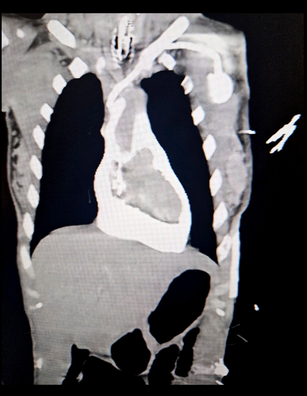 Coronal computed tomography image demonstrating a focal filling defect within the superior vena cava, adjacent to the distal tip of the indwelling port-a-cath, consistent with catheter-associated thrombus.