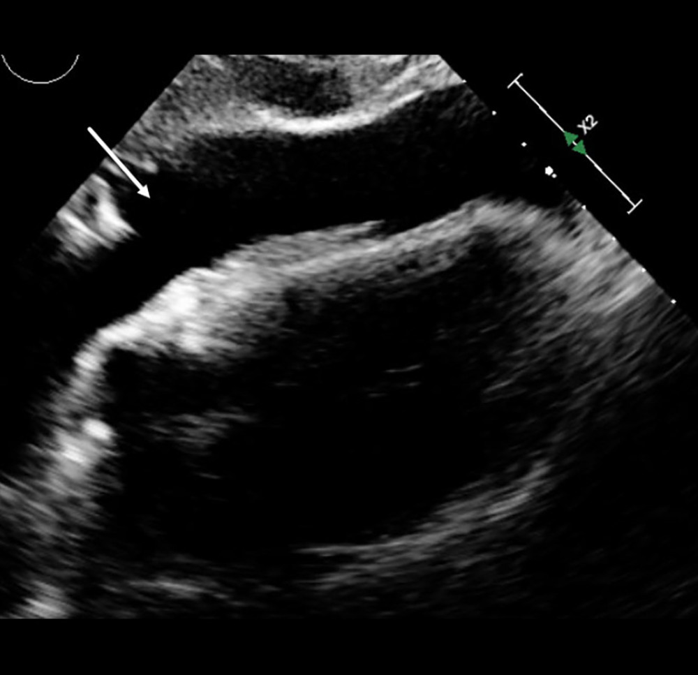 Bedside transthoracic echocardiography demonstrating a large pericardial effusion with right ventricular diastolic collapse, consistent with acute cardiac tamponade. Arrow indicates the effusion compressing the right ventricle.