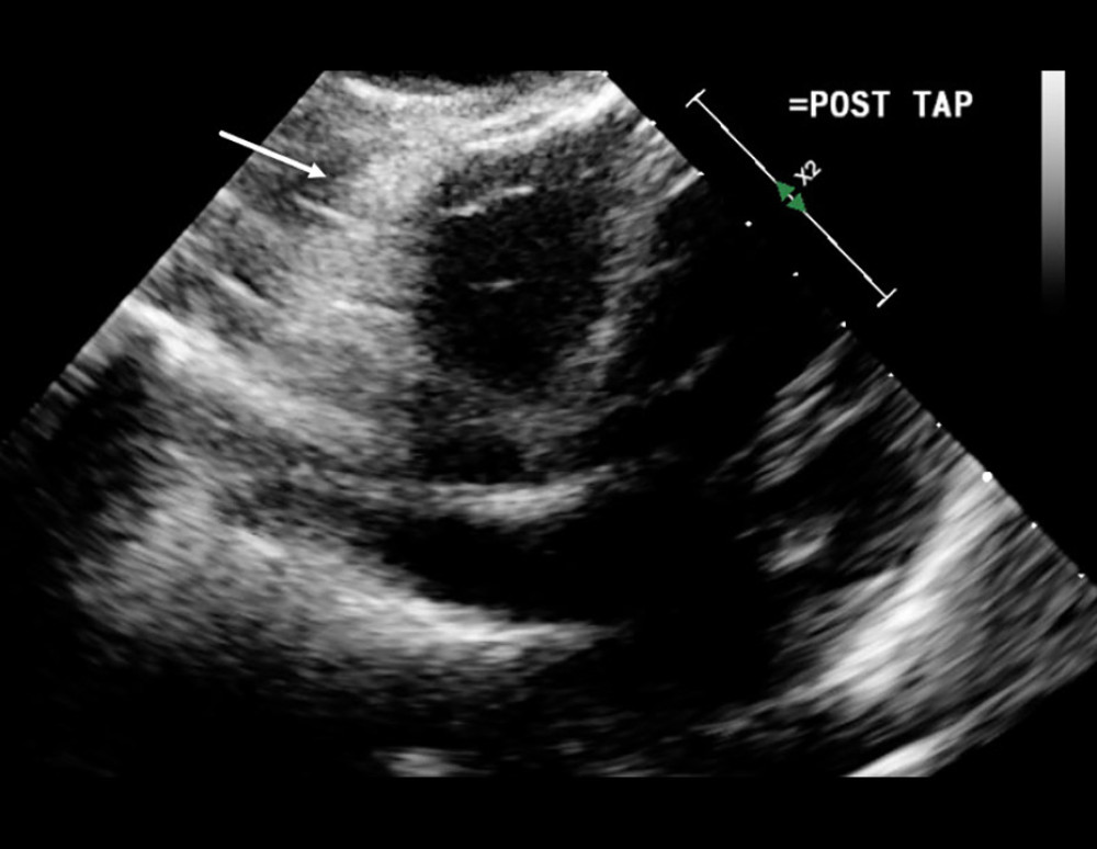 Follow-up transthoracic echocardiography after pericardiocentesis demonstrating resolution of the pericardial effusion and normalization of cardiac chamber filling. Arrow indicates the now-decompressed pericardial space.