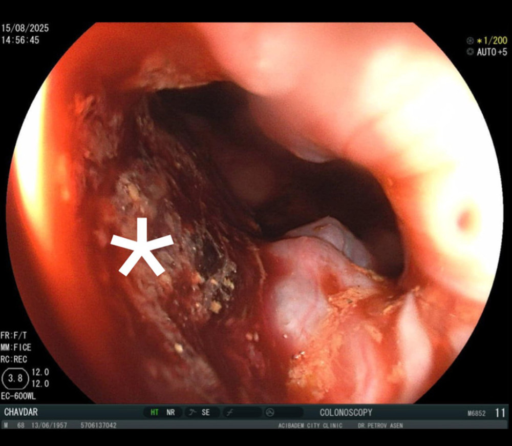 Colonoscopic view. Multifocal and diffuse hemorrhage was observed (*).