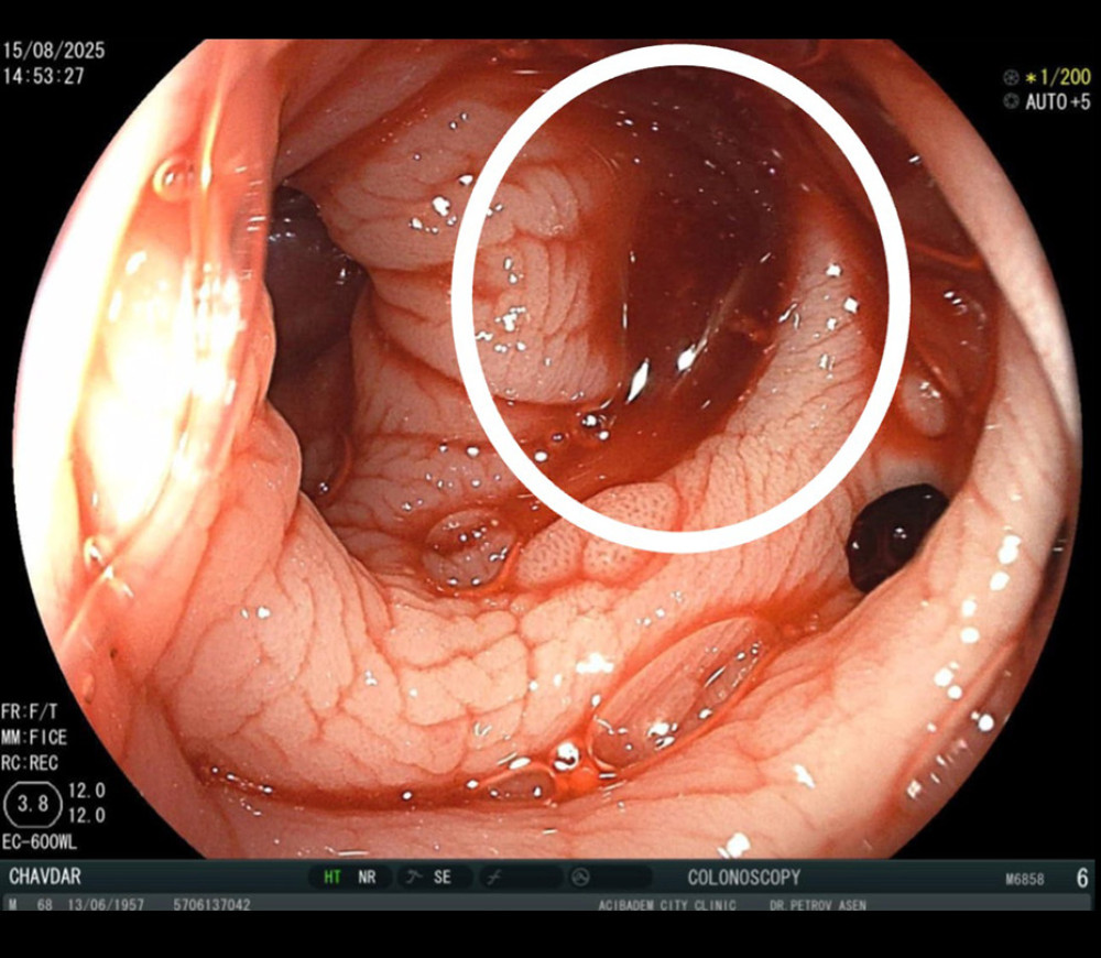 Colonoscopic view. Diffuse bleeding of the colon haustra (white circle). No blood clots were visible.