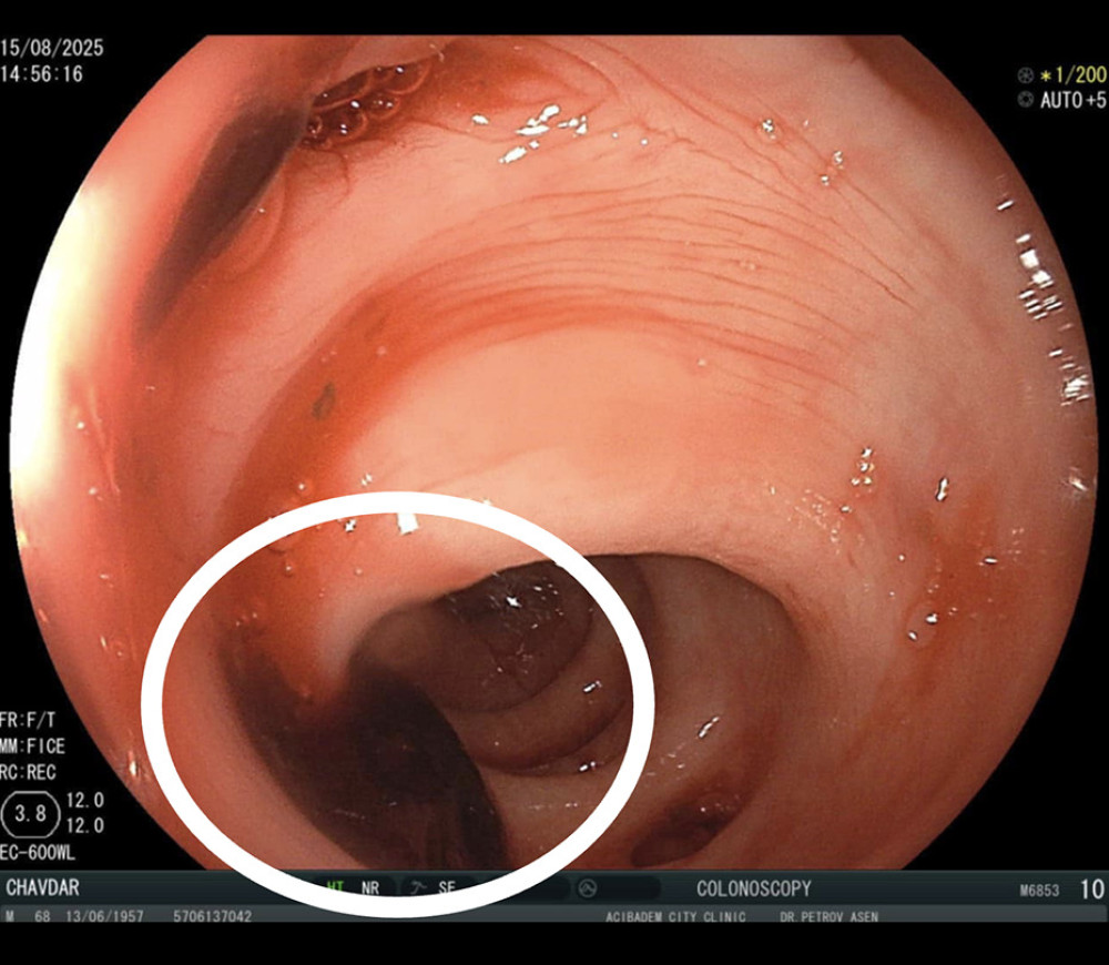 Colonoscopic view. Blood clots within the colon haustra (white circle).