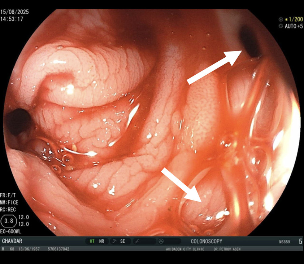 Colonoscopic view. Diverticulosis of the left colon (white arrows).