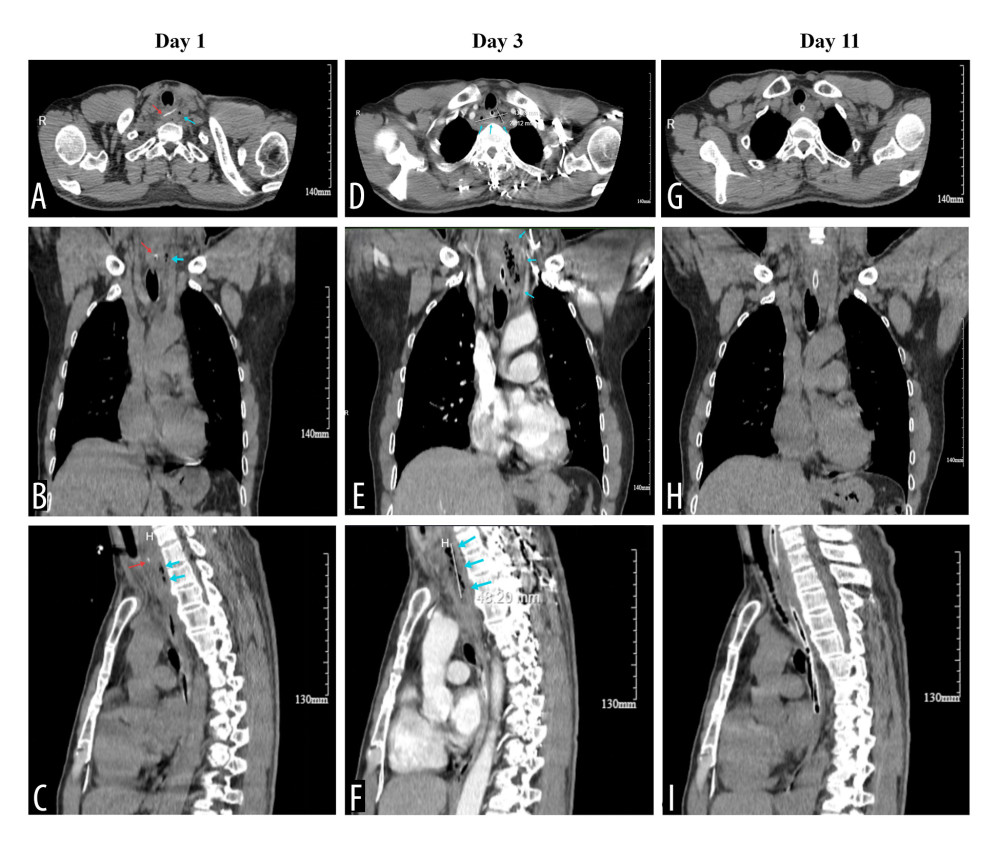 Serial computed tomography (CT) images demonstrating the evolution of cervical esophageal perforation with abscess formation. (A–C) Pre-admission CT images showing the fish bone (red arrows) impacted in the cervical esophagus with periesophageal air (blue arrows). (D–F) CT images on day 3 of hospitalization (48 hours after admission) showing abscess expansion. (D) Axial view demonstrating the abscess measuring 43 × 20 mm at its maximal cross-section. (F) Sagittal view showing a craniocaudal length of approximately 48 mm; the blue arrows indicate the abscess cavity. (G–I) CT images on day 11 of hospitalization (8 days after initiation of simplified negative-pressure nasoesophageal drainage) showing resolution of the abscess with residual esophageal wall edema.