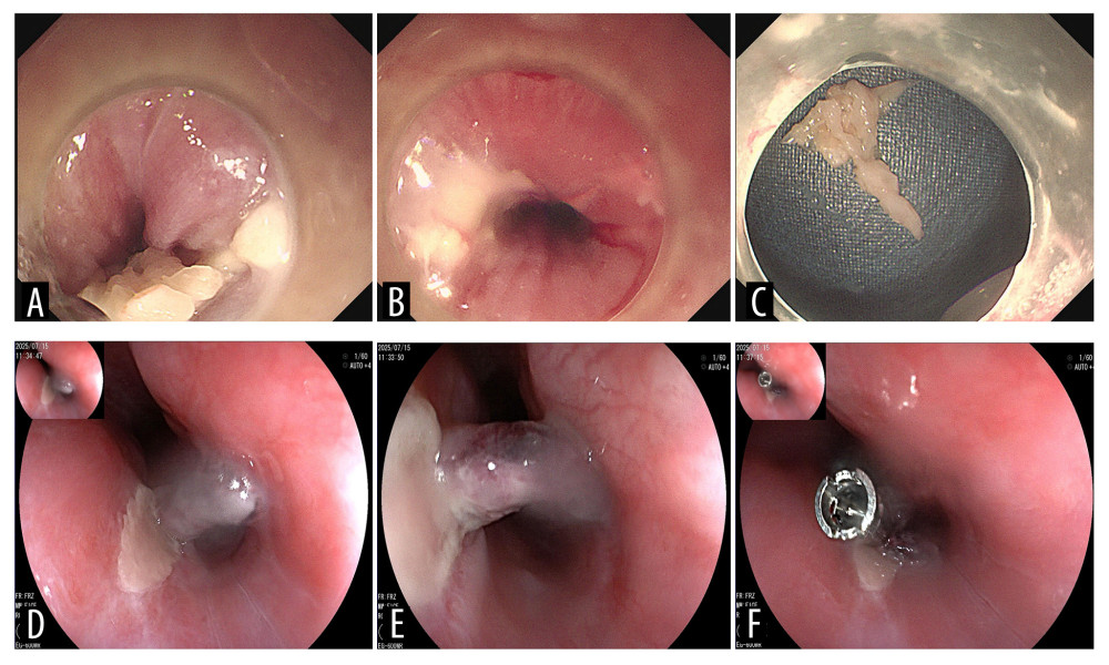 Endoscopic images of the patient. (A–C) Initial endoscopy was performed on day 1 using an Olympus GIF-290 gastroscope with a transparent cap attached to the distal tip. (A) Fish bone was impacted at the esophageal entrance (cervical esophagus) and penetrated the left esophageal wall. (B) A penetrating ulcer was found on the left esophageal wall (20 cm from the incisors) after foreign body removal. (C) T-shaped fish bone (transverse diameter approximately 2 cm) covered with food debris. (D–F) Follow-up endoscopy performed on Day 11 (8 days after initiation of simplified negative-pressure nasoesophageal drainage) using a Fujifilm EG-600WR gastroscope, showing the left upper esophageal wall at 18–20 cm from the incisors. (D) Healing mucosa with superficial ulceration. (E) Necrotic eschar at the ulcer base on the left esophageal wall. (F) Residual superficial ulcer with purplish skin tag at the distal edge, closed with a titanium clip.
