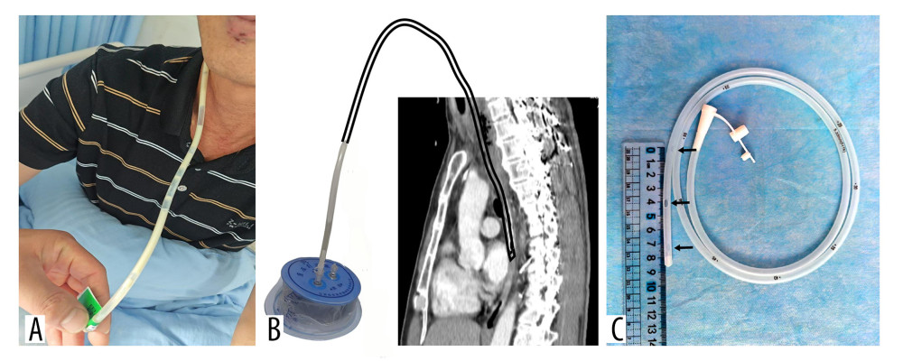 The simplified negative-pressure nasoesophageal drainage (SNPND) device and procedural demonstration. (A) Clinical photograph showing yellow purulent effluent drained through the nasogastric tube. (B) Composite schematic illustration combining the disposable negative pressure drainage ball and sagittal computed tomography imaging, demonstrating the SNPND procedure. The end of the nasogastric tube is positioned in the mid-esophagus, and it is connected to the external negative pressure ball. (C) Close-up photograph of the distal end of the 16-Fr nasogastric tube, showing 3 factory-manufactured side holes (each 3 mm in diameter) spaced 3 cm apart at different orientations along the distal segment.