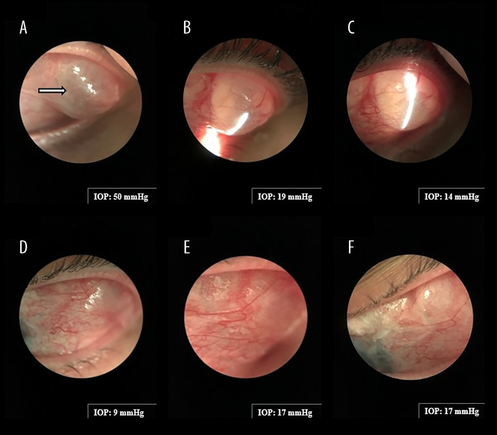 Slit-lamp photographs and intraocular pressure (IOP) measurements of the left eye (OS) from initial presentation through 2 months after initiation of medical therapy(A) At initial presentation, an enlarged superotemporal bleb overlying the Ahmed plate (white arrow) was observed, with an IOP of 50 mm Hg. The bleb appeared distended and fluid-filled, causing distortion of the upper eyelid. (B) After 1 day of medical therapy, IOP decreased to 19 mm Hg. The bleb remained enlarged with persistent upper eyelid distortion; however, its firmness and degree of protrusion were reduced relative to those at presentation. (C) After 5 days of medical therapy, IOP further decreased to 14 mm Hg. The bleb remained mildly distended, with continued reduction in size and less upper eyelid distortion. (D) After 19 days of medical therapy, IOP decreased to 9 mm Hg. The bleb returned to its baseline appearance. (E) After 1 month of medical therapy, IOP stabilized at 17 mm Hg. The bleb maintained a normal appearance, with mild erythema of the overlying conjunctiva. (F) After 2 months of medical therapy, IOP remained stable at 17 mm Hg. The bleb maintained a normal appearance, with mild residual localized erythema.