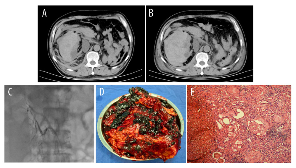 A 68-year-old man with dialysis-associated acquired cystic kidney disease presented with spontaneous intracystic hemorrhage. (A) Computerized tomography (CT) of the abdomen showed a large right perirenal hematoma with a fluid-hematocrit level. (B) CT of the abdomen was re-examined, showing the volume of the subcapsular hematoma on the right side increased. (C) Digital subtraction angiography showed multiple irregular patchy areas of contrast extravasation at the distal end of the right renal artery. (D) Cystic lesions and blood clots were observed at the site of renal rupture. (E) Glomerulosclerosis and tubular dilatation were observed in the renal parenchyma surrounding the ruptured hematoma.