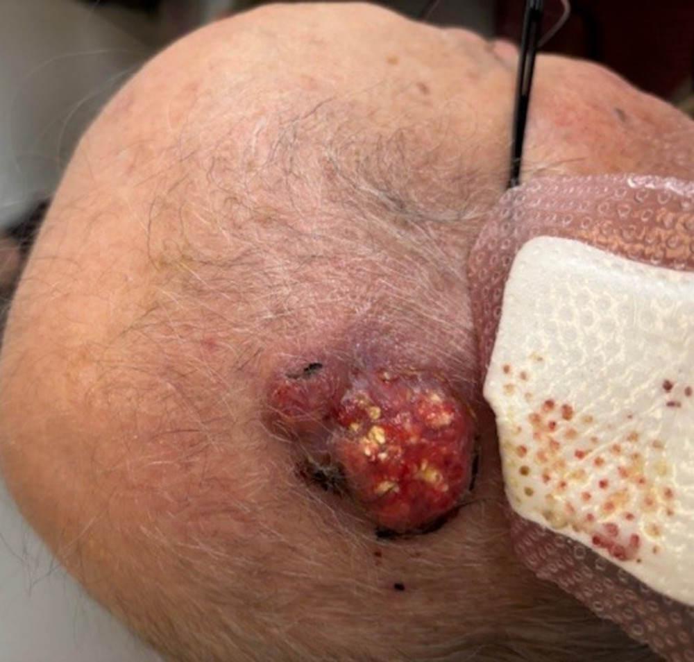 Clinical photography of lesion 2 months prior to surgical excision. Freely mobile, ulcerated, and erythematous lesion on the scalp, measuring 5 cm in its largest diameter, with no bone involvement.