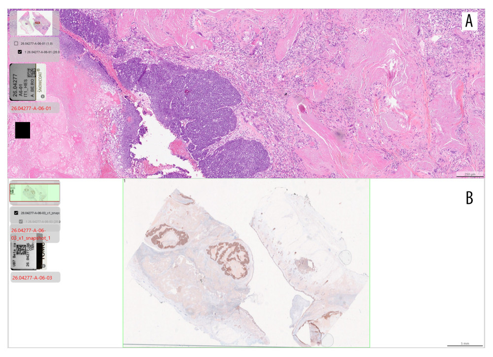 Histopathological section: (A) H&E: Well-circumscribed, lobulated dermal neoplasm. At the cellular level, it shows islands of basaloid cells with mitotic activity, exhibiting abrupt keratinization into anucleated ghost cells. The tumor keratin has elicited a foreign-body giant cells granulomatous inflammatory response. No signs of invasion or atypical features are present. (B) Immunohistochemistry (beta-catenin): Low-power view showing nuclear and membranous positivity. The areas of shadow cells and keratins remain negative.