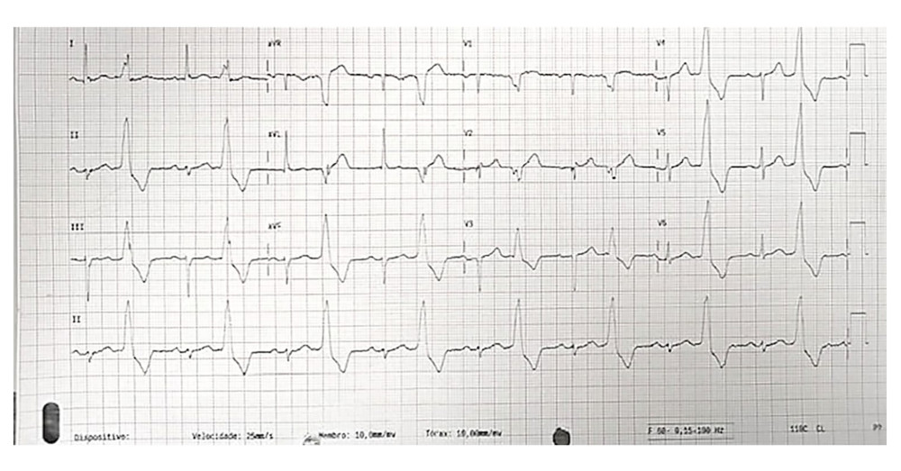 Emergency department 12-lead electrocardiogram (ECG). The 12-lead ECG shows sinus rhythm with frequent premature ventricular complexes (PVCs). The PVCs have left bundle branch block-like morphology, inferior axis, and early precordial transition, with an R/S ratio greater than 1 in lead V2.