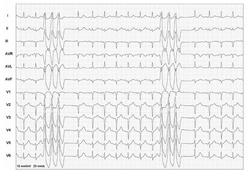 Intensive care unit electrocardiogram (ECG). The ECG shows nonsustained monomorphic ventricular tachycardia (NSVT) with the same QRS morphology as the premature ventricular complexes seen on the admission ECG, supporting a shared arrhythmogenic focus. Limb-lead analysis shows higher R-wave amplitude in lead II than in lead III and absence of septal q waves in leads I, II, and III. These findings support an anterosuperior left ventricular epicardial origin and are suggestive of left ventricular summit ventricular tachycardia.