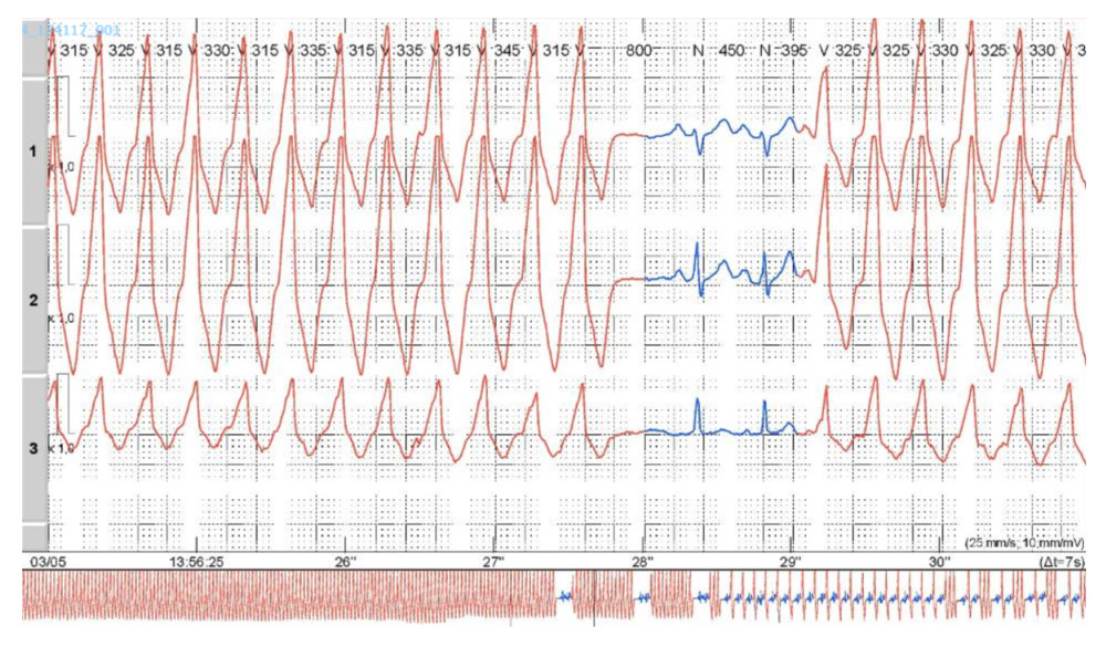 Twenty-four-hour Holter monitoring. The 24-hour Holter monitoring demonstrated a ventricular ectopic burden of approximately 65%, with frequent monomorphic premature ventricular complexes and recurrent sustained and nonsustained ventricular tachycardia, all sharing the same morphology as the index electrocardiogram.