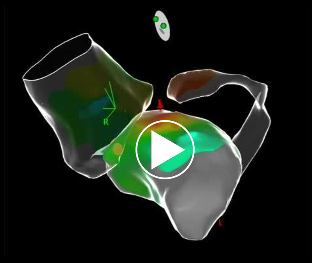 Electrophysiological mapping. Activation mapping demonstrates the earliest ventricular activation in the region corresponding to the left ventricular summit, at a safe distance from the coronary arteries.