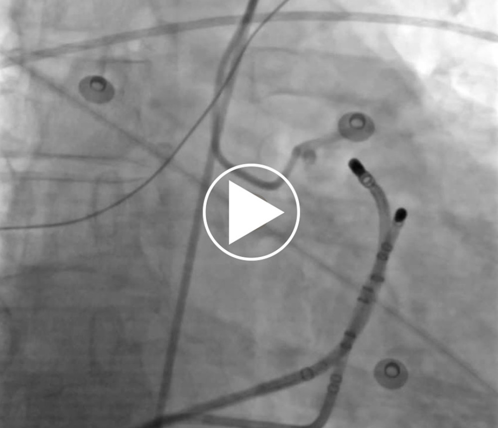 Ablation strategy. Stepwise radiofrequency ablation from anatomically adjacent sites resulting in immediate and sustained suppression of ventricular arrhythmias.