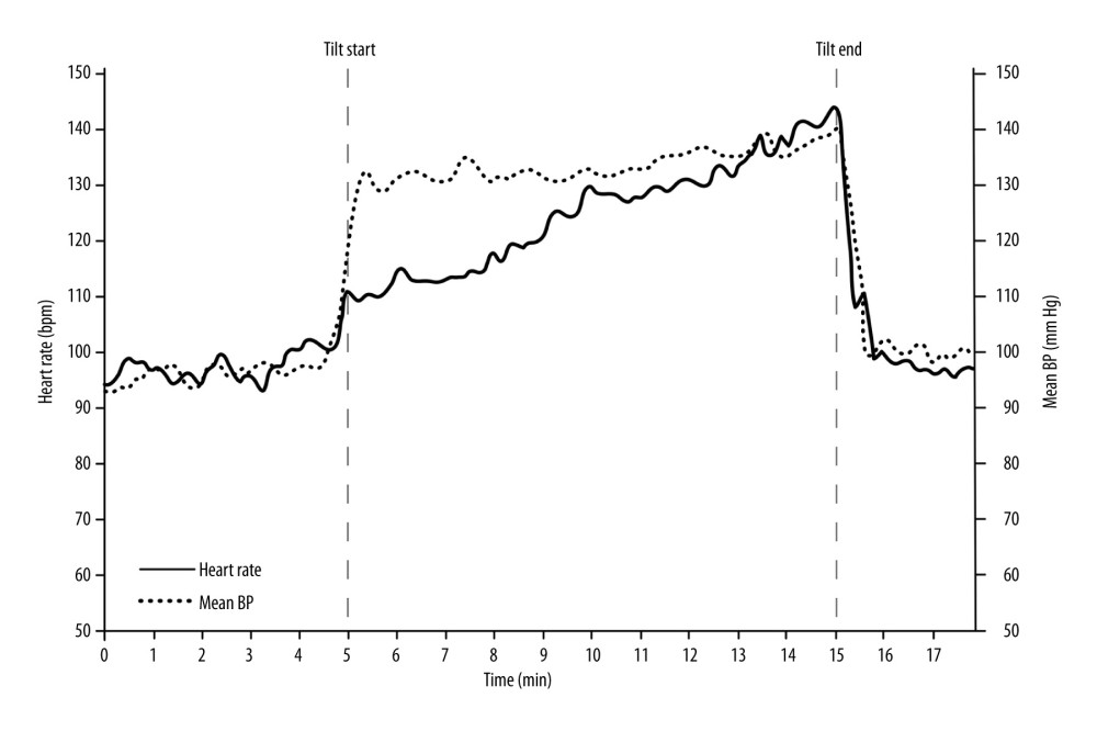 Continuous heart rate and blood pressure during head-up tilt table test. Heart rate increases from 95 beats/min at baseline to 144 beats/min within 10 minutes of upright posture without fall in blood pressure, consistent with postural orthostatic tachycardia syndrome (excessive orthostatic tachycardia defined as > 40 beats/min for ages 12–19 years) [17].